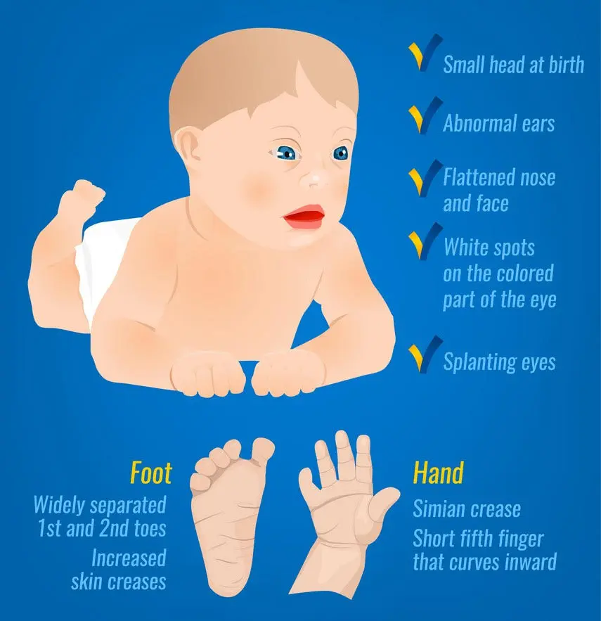 Down-Syndrome-Symptoms